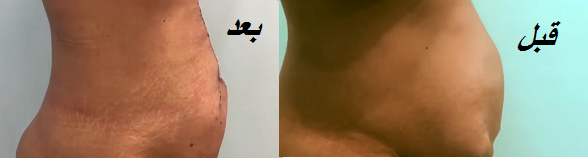 جراحة الفتق