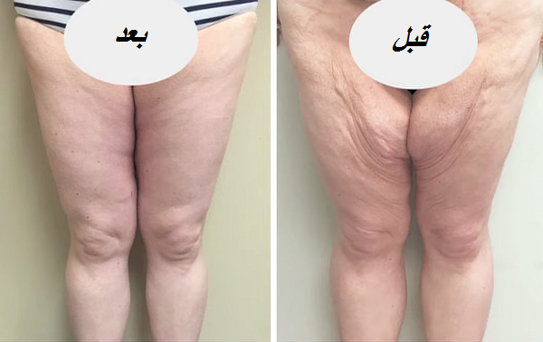 شد ترهلات الفخدين أفضل دكتور تجميل في القاهرة
