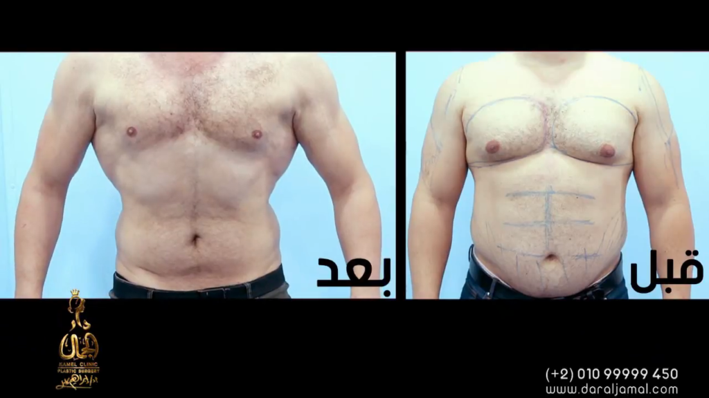 التثدي عند الرجال أفضل دكتور جراحة تجميل في مصر