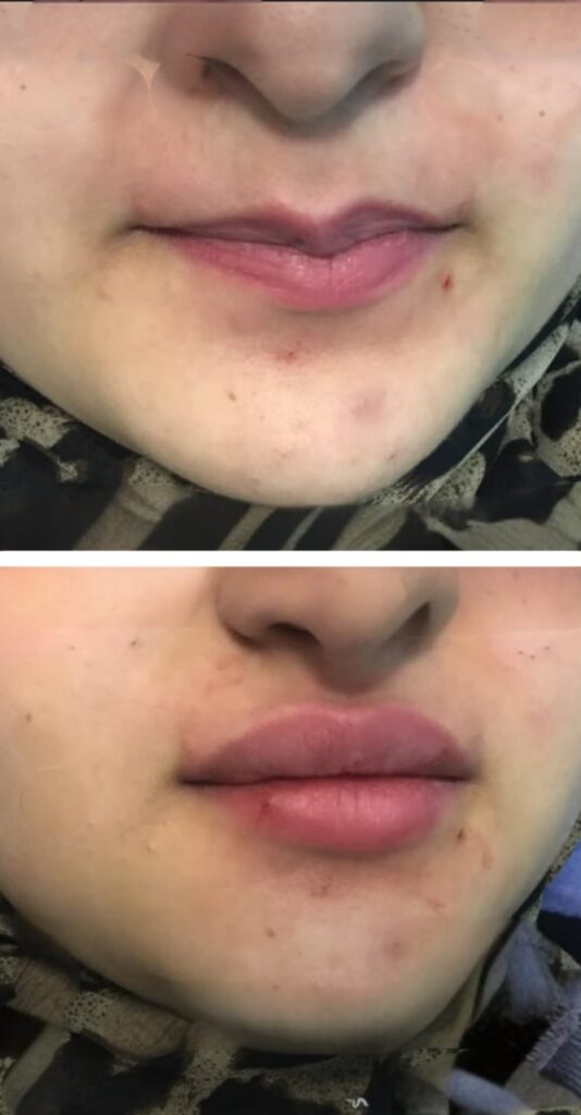 تجميل الشفاه