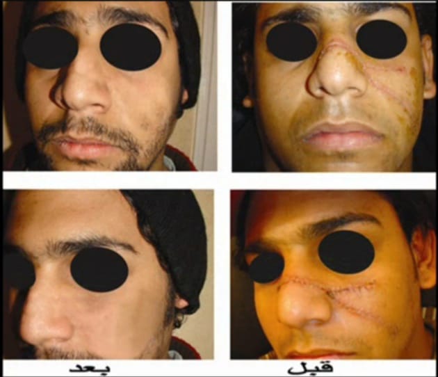 علاج آثار الجروح بالليزر