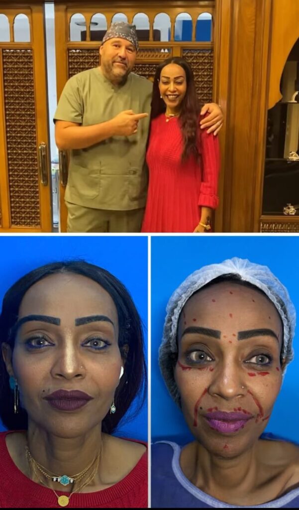 تجميل الوجه بالخلايا الجذعية