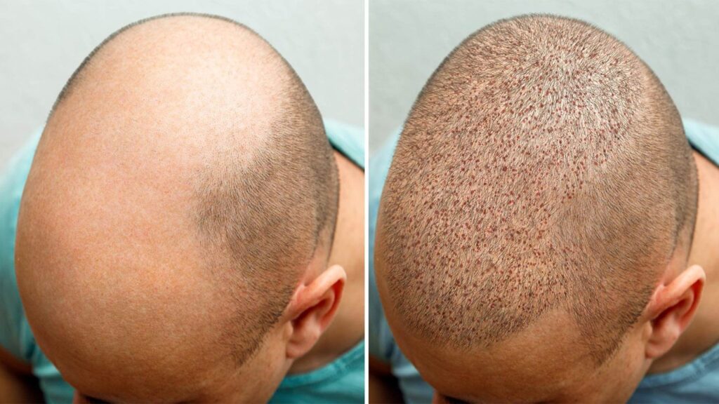 زراعة الشعر كم سنة تدوم عملية زراعة الشعر