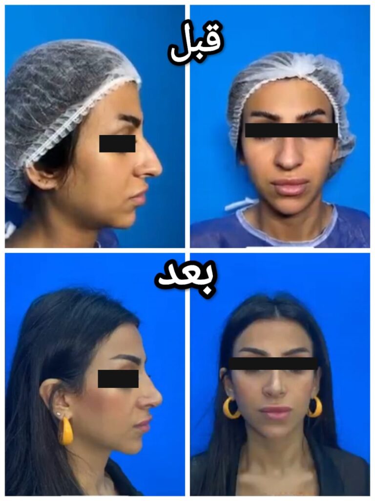 عملية تجميل الأنف
