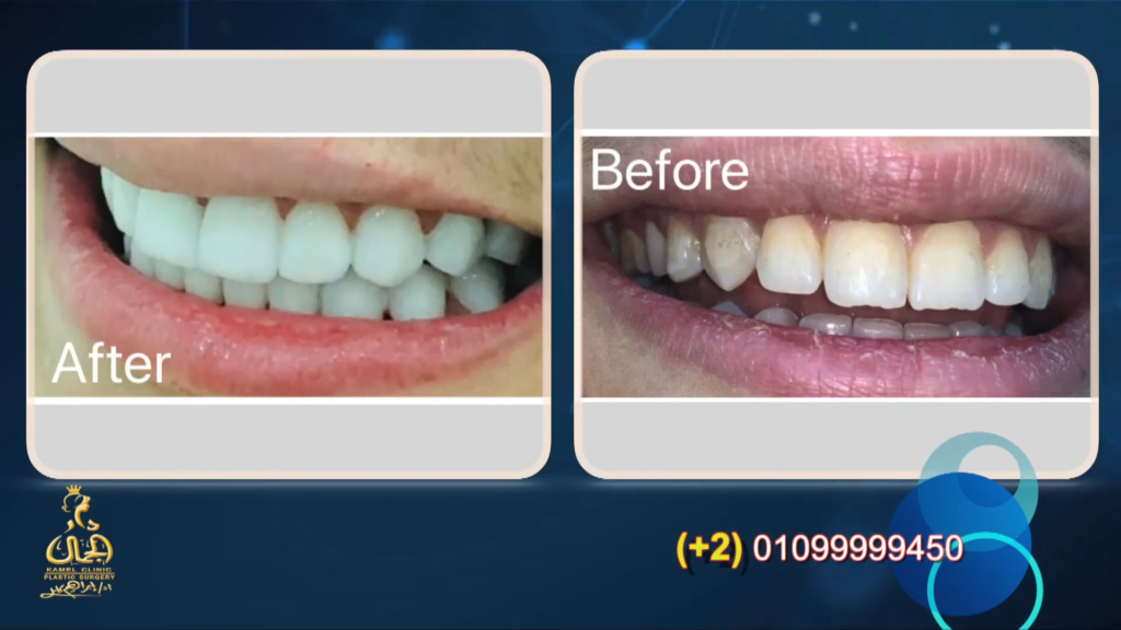 تجميل الأسنان
