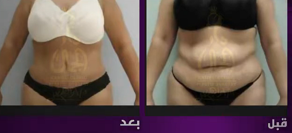 عمليات التحسيس كم يكلف شفط الدهون في مصر