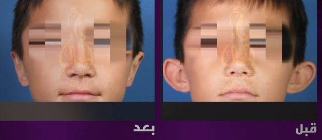 افضل دكتور تجميل الاذن ما هي أنواع عمليات التجميل