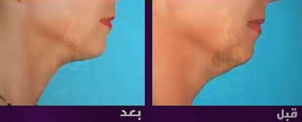 تجارب عملية شد الرقبة تجارب عملية شد الرقبة