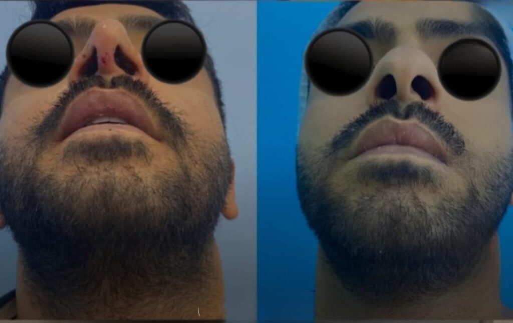 أحدث تقنية لتجميل المنخار Kamel Technique